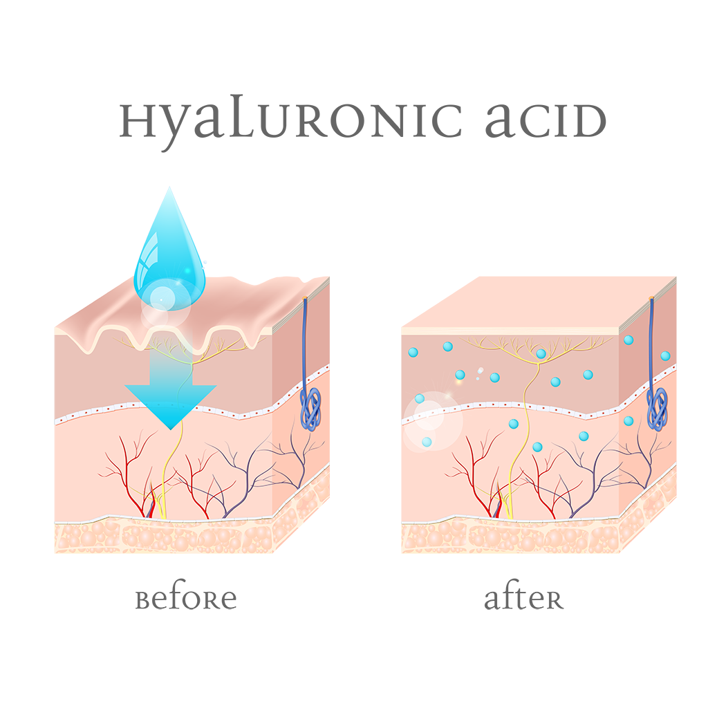 Lionesse-The-12-Skin-Benefits-of-Hyaluronic-Acid-illustration-before-and-after.png