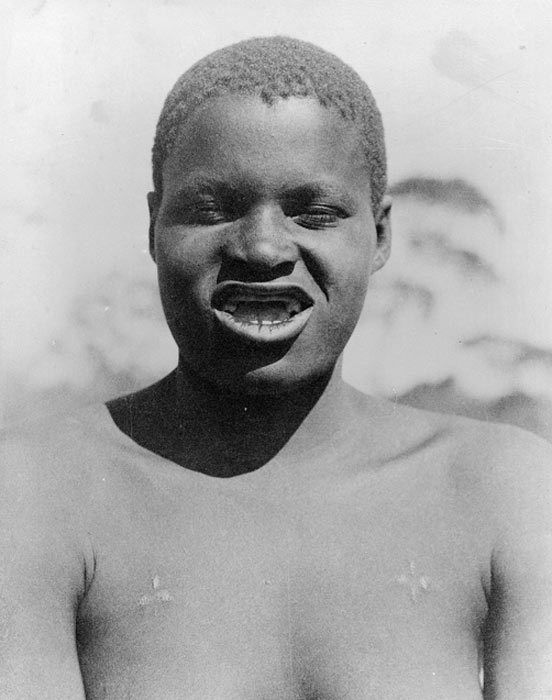 Người Batonga ở Zambia nhổ bỏ toàn bộ răng cửa hàm trên như một dấu hiệu của vẻ đẹp.