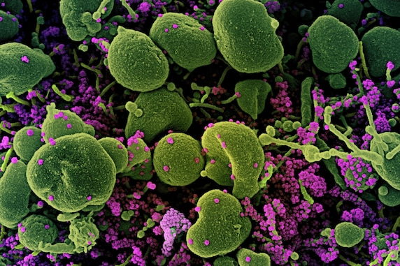 Ảnh quét màu từ kính hiển vi điện tử những tế bào (xanh lục) của một bệnh nhân nhiễm nhiều hạt virut SARS-CoV-2 (tím). Ảnh: NIAID, NIH, SCIENCE SOURCE.
