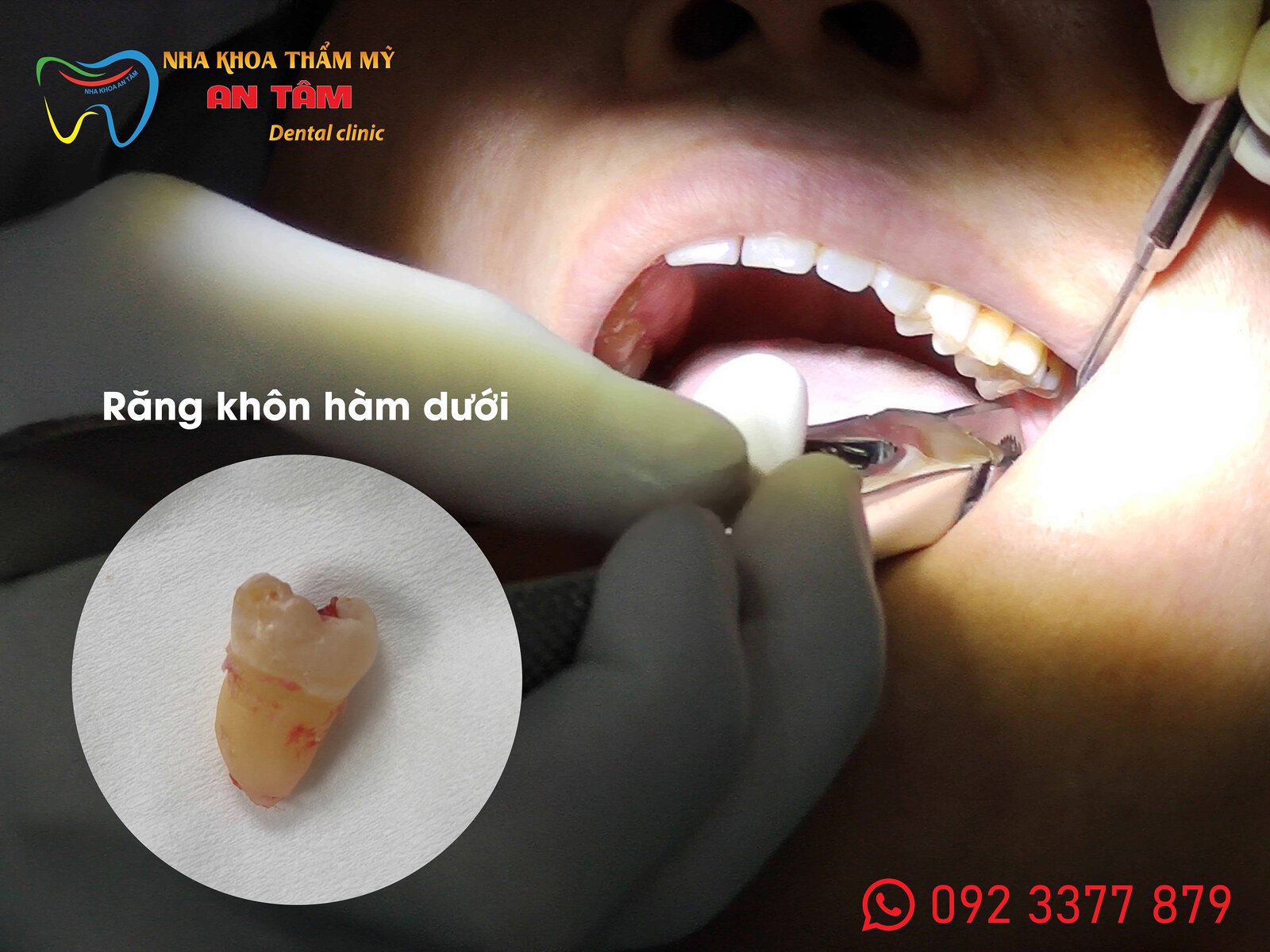 Hình ảnh khách nhổ răng khôn hàm dưới không đau tại Nha khoa An Tâm quận Gò Vấp