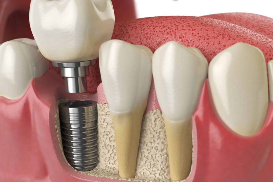 trồng răng implant có đau không.png