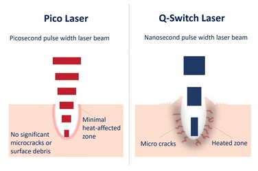 q-switch-laser-vs-pico-laser-1.jpg