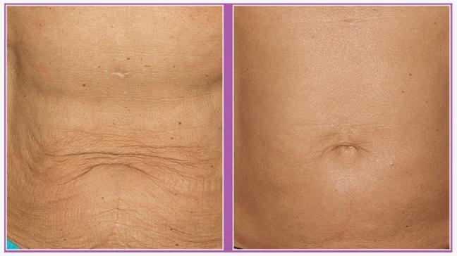 Radiofrequency-Skin-Tightening.jpg