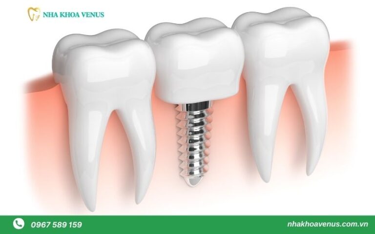 cay-ghep-implant-don-le-768x480.jpg