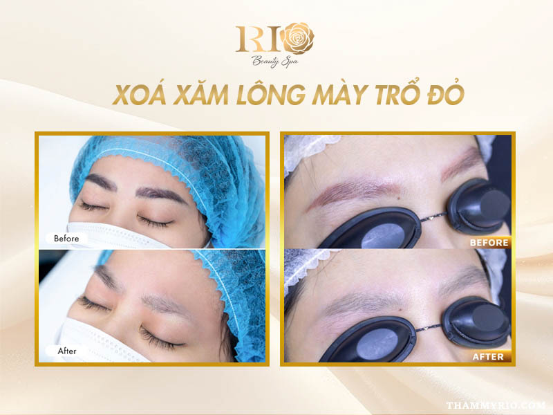 Long-may-tro-do-co-xoa-duoc-khong-7.jpg