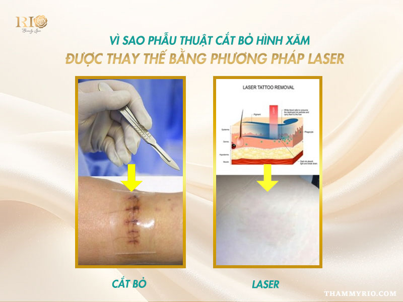 Phau-thuat-cat-bo-hinh-xam-5.jpg