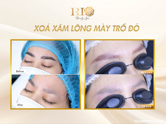 Long-may-tro-do-co-xoa-duoc-khong-7.jpg