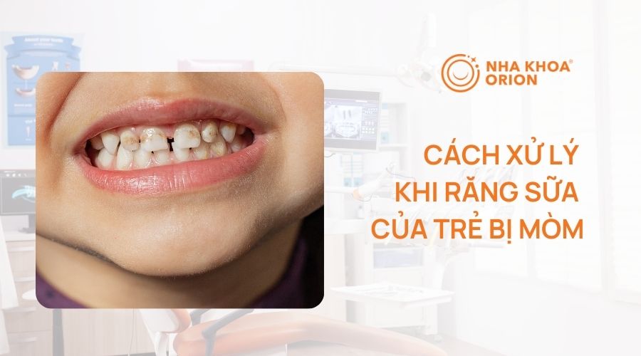 cach-xu-ly-khi-rang-sua-cua-tre-bi-mon.jpg